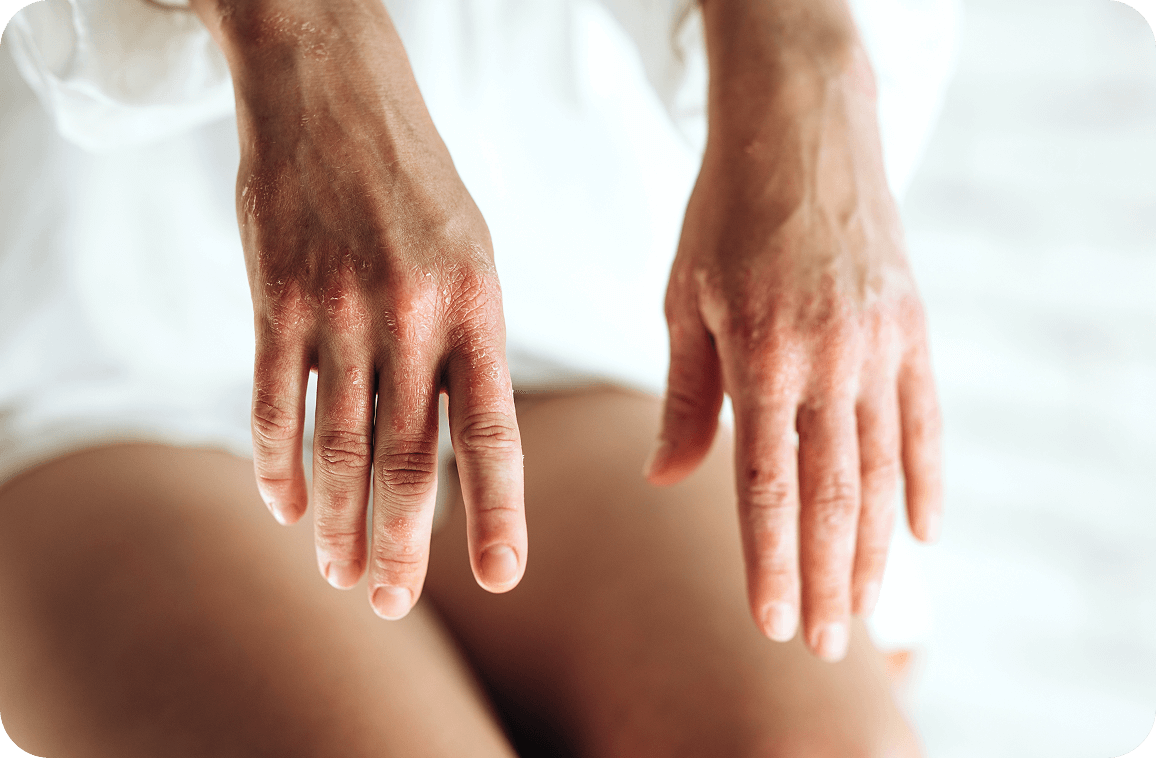 Artrite psoriásica